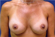Breast Augmentation After Photo by Matthew Kilgo, MD, FACS; Garden City, NY - Case 33859