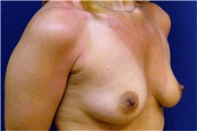 Breast Augmentation Before Photo by Matthew Kilgo, MD, FACS; Garden City, NY - Case 33859