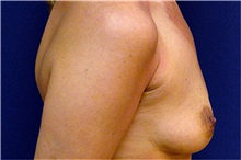 Breast Augmentation Before Photo by Matthew Kilgo, MD, FACS; Garden City, NY - Case 33859