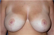 Breast Reduction After Photo by Matthew Kilgo, MD, FACS; Garden City, NY - Case 33862