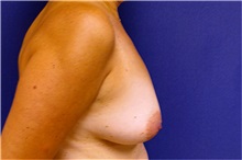 Breast Reconstruction Before Photo by Matthew Kilgo, MD, FACS; Garden City, NY - Case 33863