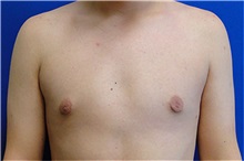 Male Breast Reduction After Photo by Matthew Kilgo, MD, FACS; Garden City, NY - Case 33864