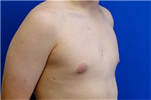 Male Breast Reduction After Photo by Matthew Kilgo, MD, FACS; Garden City, NY - Case 33864