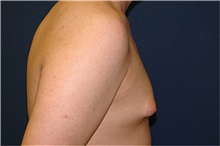 Male Breast Reduction Before Photo by Matthew Kilgo, MD, FACS; Garden City, NY - Case 33864