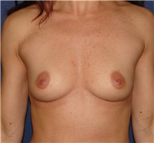 Breast Augmentation Before Photo by Matthew Kilgo, MD, FACS; Garden City, NY - Case 33866