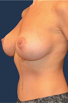 Breast Lift After Photo by Matthew Kilgo, MD, FACS; Garden City, NY - Case 33918