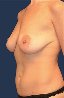 Breast Lift Before Photo by Matthew Kilgo, MD, FACS; Garden City, NY - Case 33918