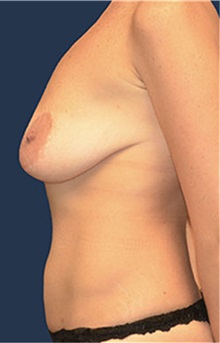 Breast Lift Before Photo by Matthew Kilgo, MD, FACS; Garden City, NY - Case 33918