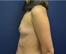 Breast Augmentation Before Photo by Matthew Kilgo, MD, FACS; Garden City, NY - Case 35298