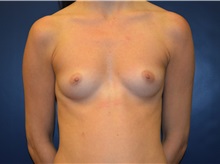 Breast Augmentation Before Photo by Matthew Kilgo, MD, FACS; Garden City, NY - Case 35301
