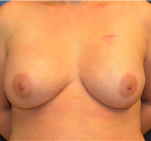 Breast Reconstruction After Photo by Matthew Kilgo, MD, FACS; Garden City, NY - Case 35304
