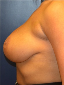 Breast Lift After Photo by Matthew Kilgo, MD, FACS; Garden City, NY - Case 35307