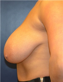 Breast Lift Before Photo by Matthew Kilgo, MD, FACS; Garden City, NY - Case 35307