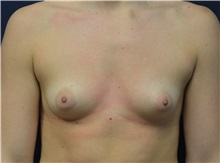 Breast Augmentation Before Photo by Matthew Kilgo, MD, FACS; Garden City, NY - Case 35308