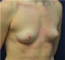 Breast Augmentation Before Photo by Matthew Kilgo, MD, FACS; Garden City, NY - Case 35308