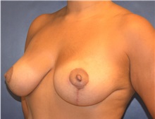 Breast Lift After Photo by Matthew Kilgo, MD, FACS; Garden City, NY - Case 35309