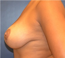 Breast Lift After Photo by Matthew Kilgo, MD, FACS; Garden City, NY - Case 35309