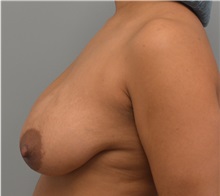 Breast Lift Before Photo by Matthew Kilgo, MD, FACS; Garden City, NY - Case 35309