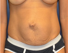 Tummy Tuck Before Photo by Matthew Kilgo, MD, FACS; Garden City, NY - Case 35312