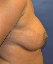 Breast Reconstruction After Photo by Matthew Kilgo, MD, FACS; Garden City, NY - Case 35313