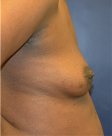 Breast Reconstruction Before Photo by Matthew Kilgo, MD, FACS; Garden City, NY - Case 35313