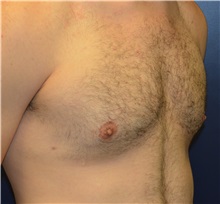 Male Breast Reduction After Photo by Matthew Kilgo, MD, FACS; Garden City, NY - Case 35314