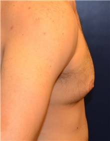 Male Breast Reduction Before Photo by Matthew Kilgo, MD, FACS; Garden City, NY - Case 35314