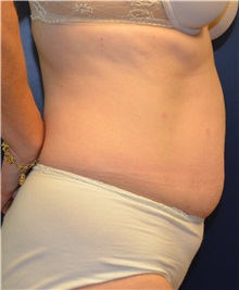Tummy Tuck Before Photo by Matthew Kilgo, MD, FACS; Garden City, NY - Case 35315