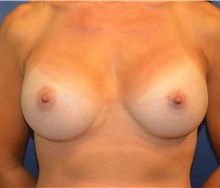 Breast Augmentation After Photo by Matthew Kilgo, MD, FACS; Garden City, NY - Case 35316