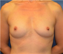 Breast Augmentation Before Photo by Matthew Kilgo, MD, FACS; Garden City, NY - Case 35316