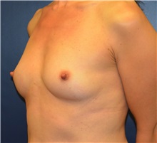 Breast Augmentation Before Photo by Matthew Kilgo, MD, FACS; Garden City, NY - Case 35316