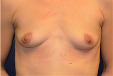Breast Augmentation Before Photo by Matthew Kilgo, MD, FACS; Garden City, NY - Case 35318