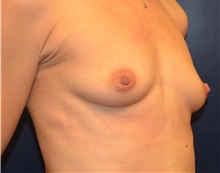 Breast Augmentation Before Photo by Matthew Kilgo, MD, FACS; Garden City, NY - Case 35318