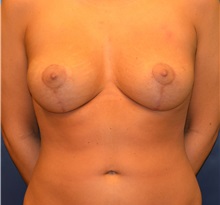 Breast Lift After Photo by Matthew Kilgo, MD, FACS; Garden City, NY - Case 35319