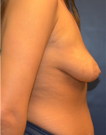 Breast Lift Before Photo by Matthew Kilgo, MD, FACS; Garden City, NY - Case 35319