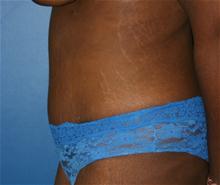 Tummy Tuck After Photo by Daniel Reichner, MD, FACS; Orange, CA - Case 28179