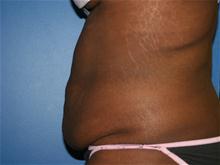 Tummy Tuck Before Photo by Daniel Reichner, MD, FACS; Orange, CA - Case 28179