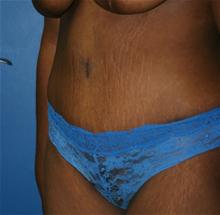 Tummy Tuck After Photo by Daniel Reichner, MD, FACS; Orange, CA - Case 28179