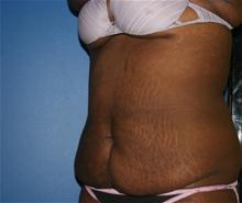 Tummy Tuck Before Photo by Daniel Reichner, MD, FACS; Orange, CA - Case 28179