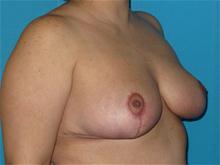 Breast Reduction After Photo by Patrick Chen, MD; Fort Worth, TX - Case 25843