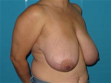 Breast Reduction Before Photo by Patrick Chen, MD; Fort Worth, TX - Case 25843