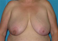 Breast Reconstruction Before Photo by Patrick Chen, MD; Fort Worth, TX - Case 25848