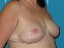 Breast Reconstruction After Photo by Patrick Chen, MD; Fort Worth, TX - Case 25848