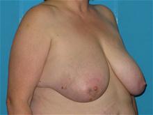 Breast Reconstruction Before Photo by Patrick Chen, MD; Fort Worth, TX - Case 25848