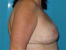 Breast Reconstruction After Photo by Patrick Chen, MD; Fort Worth, TX - Case 25848