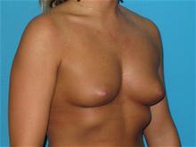 Breast Augmentation Before Photo by Patrick Chen, MD; Fort Worth, TX - Case 25852