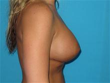 Breast Augmentation After Photo by Patrick Chen, MD; Fort Worth, TX - Case 25852