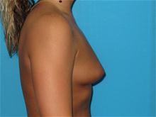 Breast Augmentation Before Photo by Patrick Chen, MD; Fort Worth, TX - Case 25852
