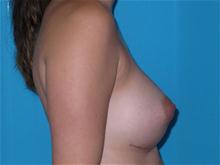 Breast Augmentation After Photo by Patrick Chen, MD; Fort Worth, TX - Case 25853
