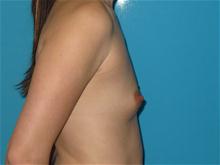 Breast Augmentation Before Photo by Patrick Chen, MD; Fort Worth, TX - Case 25853